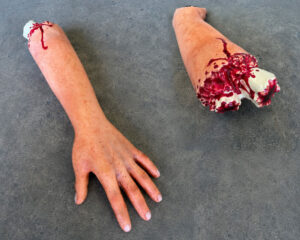 Severed Arm